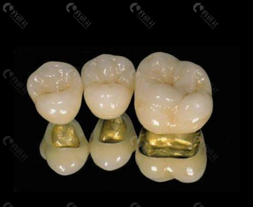 钯金烤瓷牙做牙齿修复怎么样？