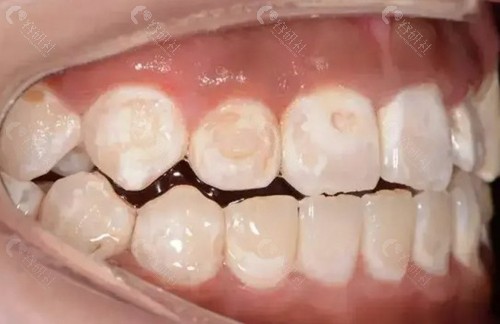 龋齿一度照片