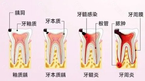 龋齿二度照片