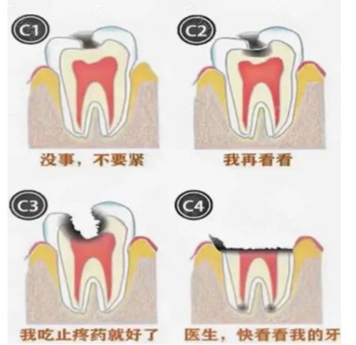 龋齿五度照片