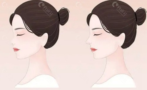 邹笑寒医生隆鼻手术特色