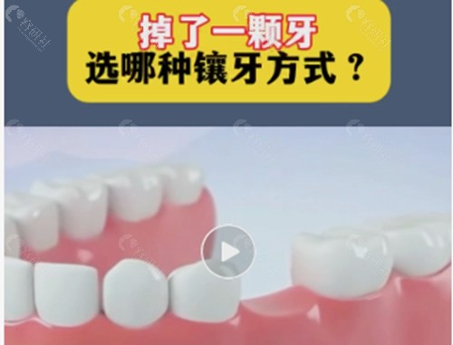重庆镶牙价格