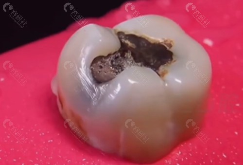黄山洞牙修复价格