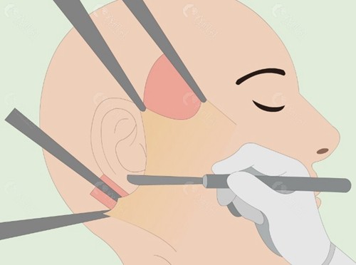 耳垂畸形矫正术价格是多少