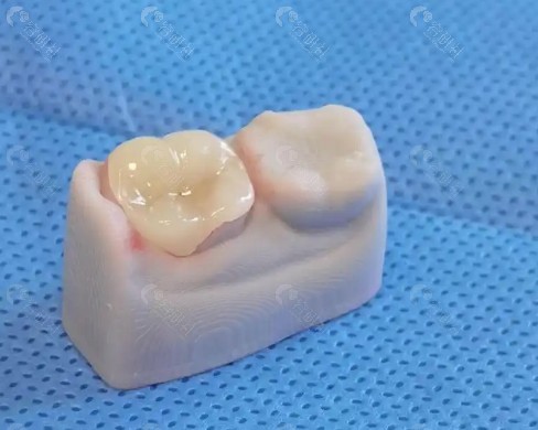 假牙材质与核磁共振检查的关系