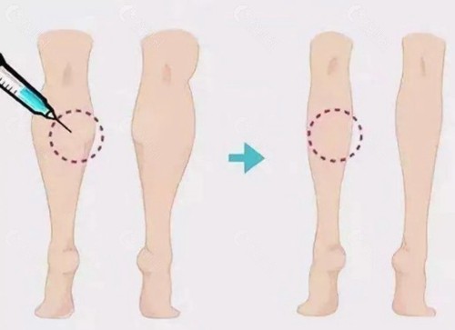 吸脂和瘦腿针可以一起做吗？
