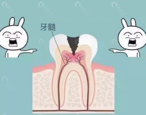 牙髓治疗和根管治疗一样吗？