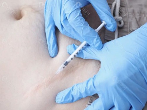 剖腹产疤痕增生怎么去除？