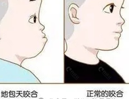 地包天矫正价格