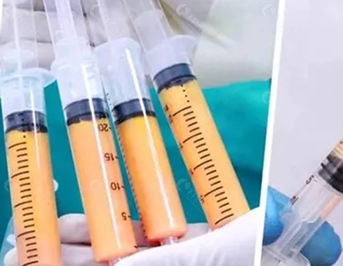 刘中国脂肪丰胸可靠吗
