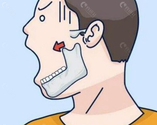 罗延平和何锦泉做磨骨手术哪个好