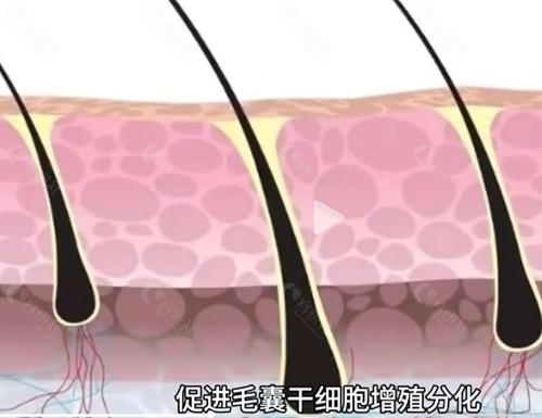 干细胞培养液治疗脱发效果好吗？