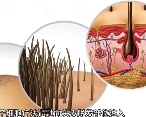 干细胞植发技术成熟吗