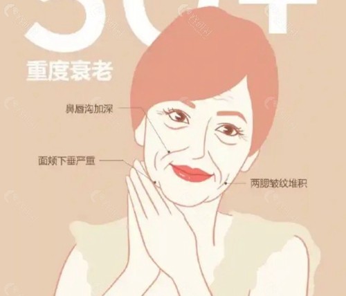 面部黄金支架提升