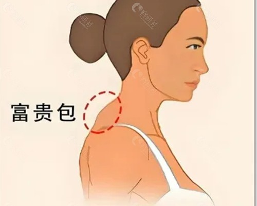 富贵包治疗方法