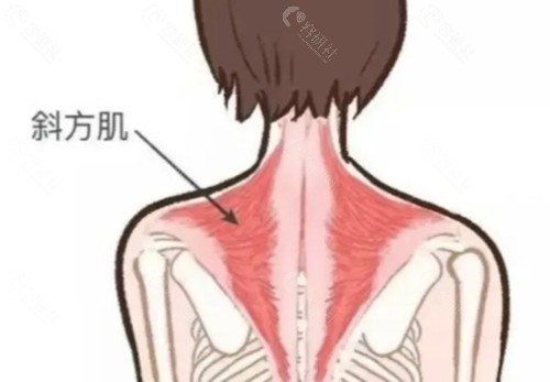 斜方肌消除方法