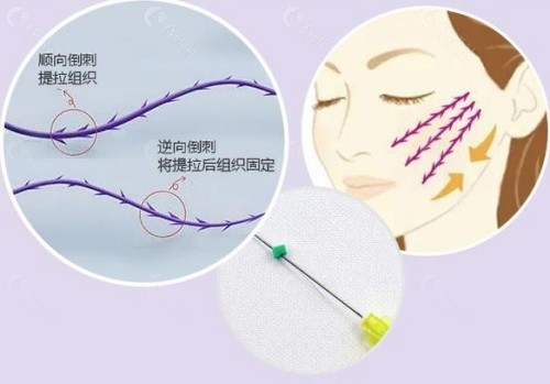 埋线提升怎么样？