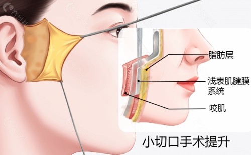 拉皮手术优势介绍