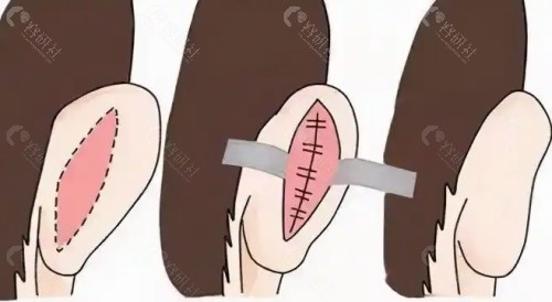 招风耳术后注意事项