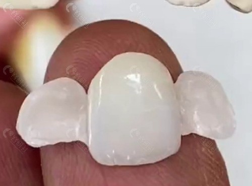 马里兰桥修复义齿照片