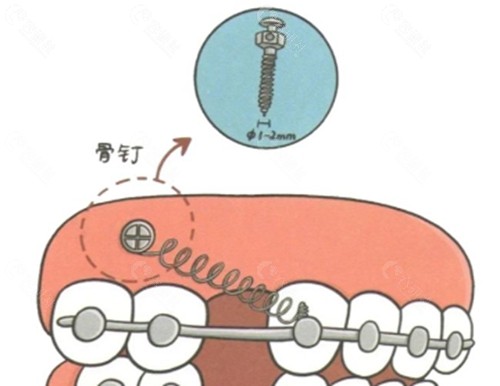打骨钉价格