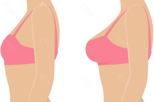 女性乳房棒棒糖缩胸和倒T法缩胸哪个好？