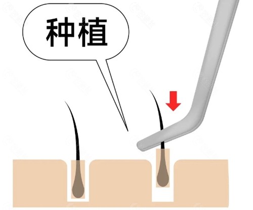 南京植发收费价格表