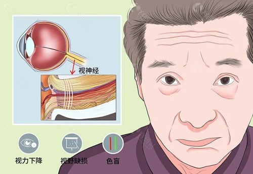视神经萎缩怎么治疗？
