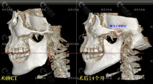 张笑天颧骨内推优势介绍