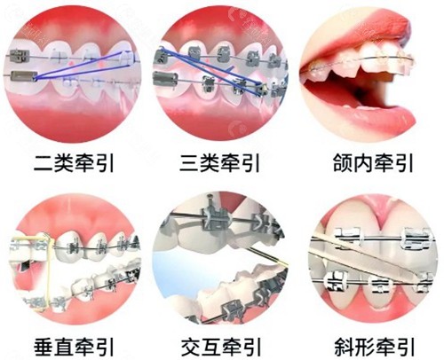 正畸牵引埋伏牙方法图片