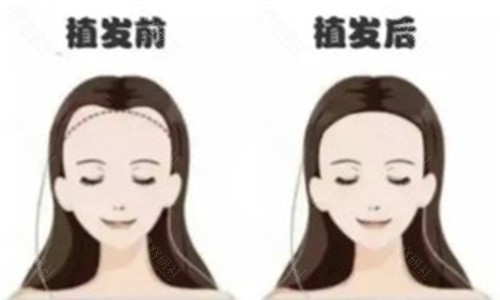 2025青穗植发医院收费价格表