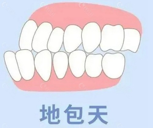 反颌牙齿图片