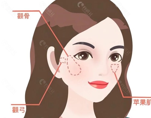 颧骨外扩和颧骨高区别
