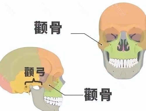 颧骨外扩改善方法