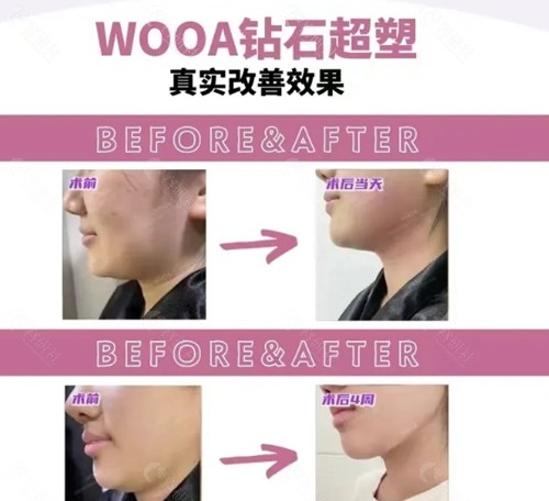 韩国WOOA整形医院钻石超塑好吗