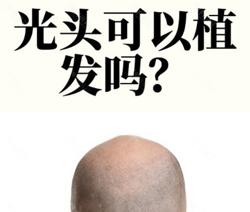 光头可以种植头发吗
