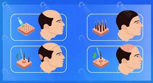 市民做植发手术口碑反馈