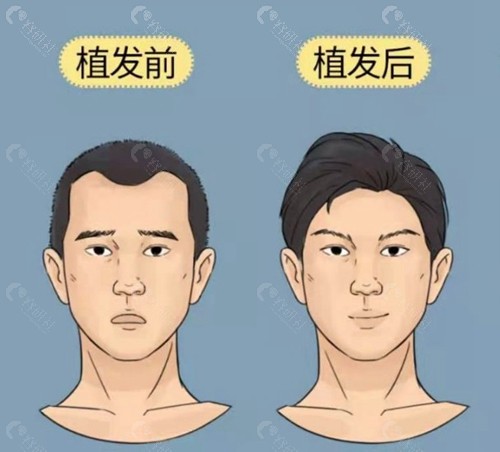物理增发和植发哪个好？