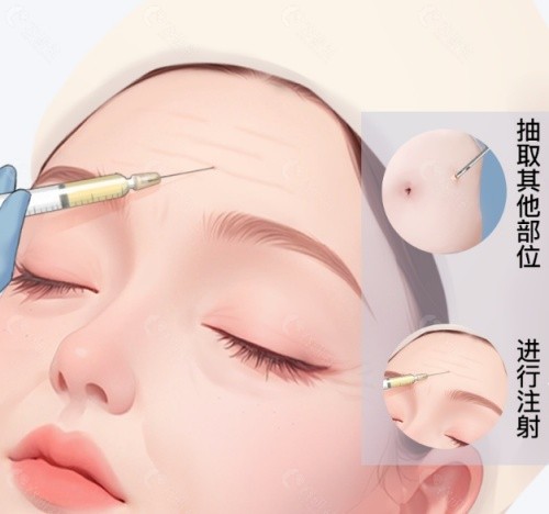 自体脂肪可以填充法令纹吗？