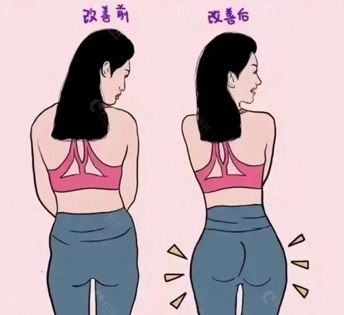 大腿吸脂后臀部下垂怎么办？