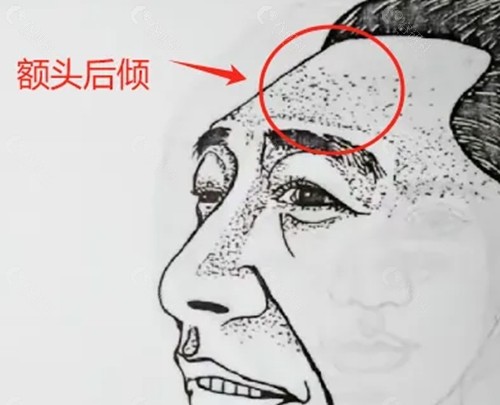 额头后倾改善方法