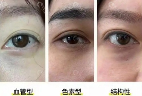 怎么看自己的黑眼圈是什么类型？