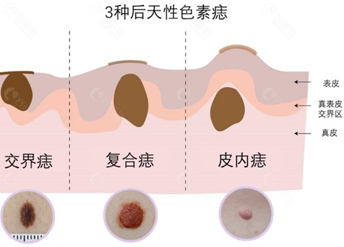 激光祛痣多久能恢复好