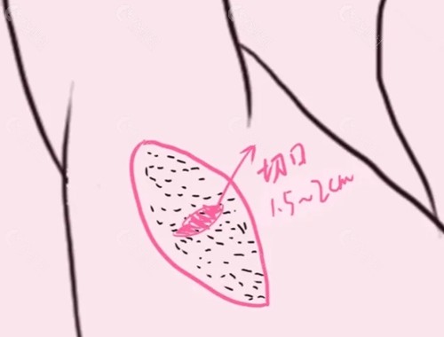 汉中腋臭治疗价格