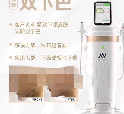 钻石超声炮和半岛超声炮区别