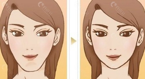 杭州下颌角磨骨价格是多少