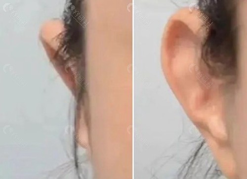 贴发耳矫正手术的价格影响因素有哪些？