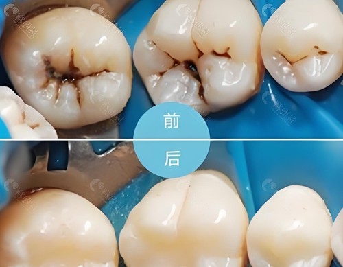宜昌补牙价格