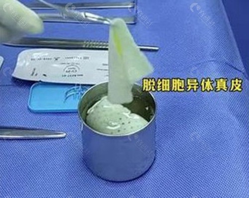 生物补片增粗后变短的原因