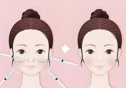 馒化脸形成的原因与修复难点